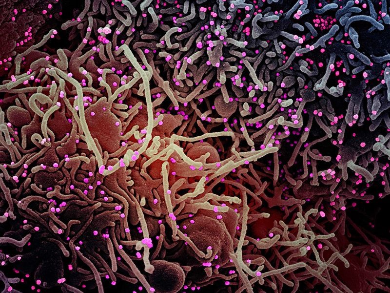 Ảnh vi điện tử quét màu của một tế bào VERO E6 (màu tím) có cấu trúc kéo dài và dấu hiệu của sự chết rụng sau khi bị nhiễm các hạt virus SARS-CoV-2 (màu hồng), được phân lập từ mẫu của bệnh nhân. Ảnh: NIAID/AFP.