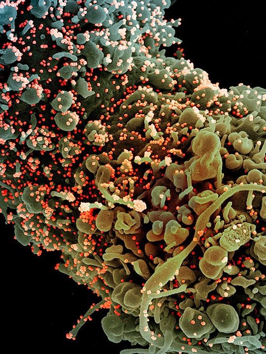 Một tế bào cho thấy các dấu hiệu hình thái của apoptosis, bị nhiễm các hạt virus SARS-COV-2 (màu cam), được phân lập từ một mẫu bệnh nhân.