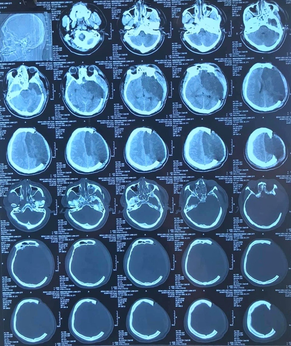 Hình ảnh CT Scan sọ sau phẫu thuật mở sọ giảm áp. Ảnh: BVCC