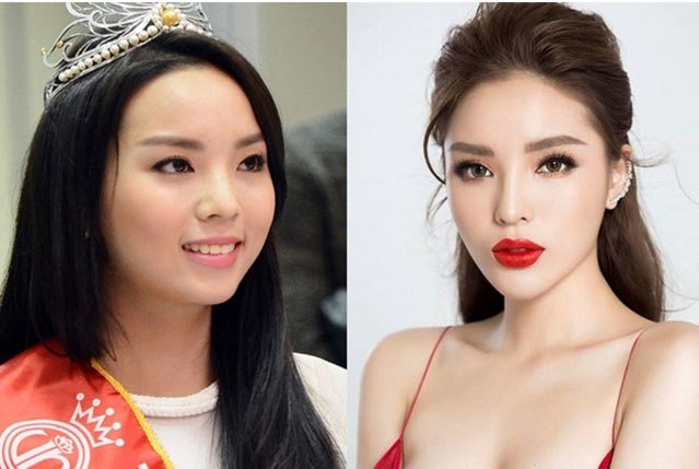 Hoa hậu Nguyễn Cao Kỳ Duyên trước và sau khi thẩm mỹ. Ảnh: Sen Vàng