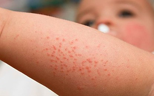 Triệu chứng sốt xuất huyết ở trẻ em và cách phòng bệnh