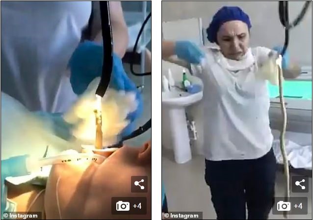 Con rắn được kéo ra từ họng của nữ bệnh nhân Nga. Ảnh: Daily Mail.