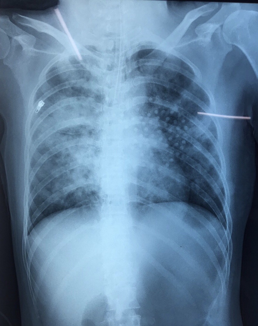 Hình ảnh phổi của bệnh nhân. Ảnh: Bệnh viện cung cấp