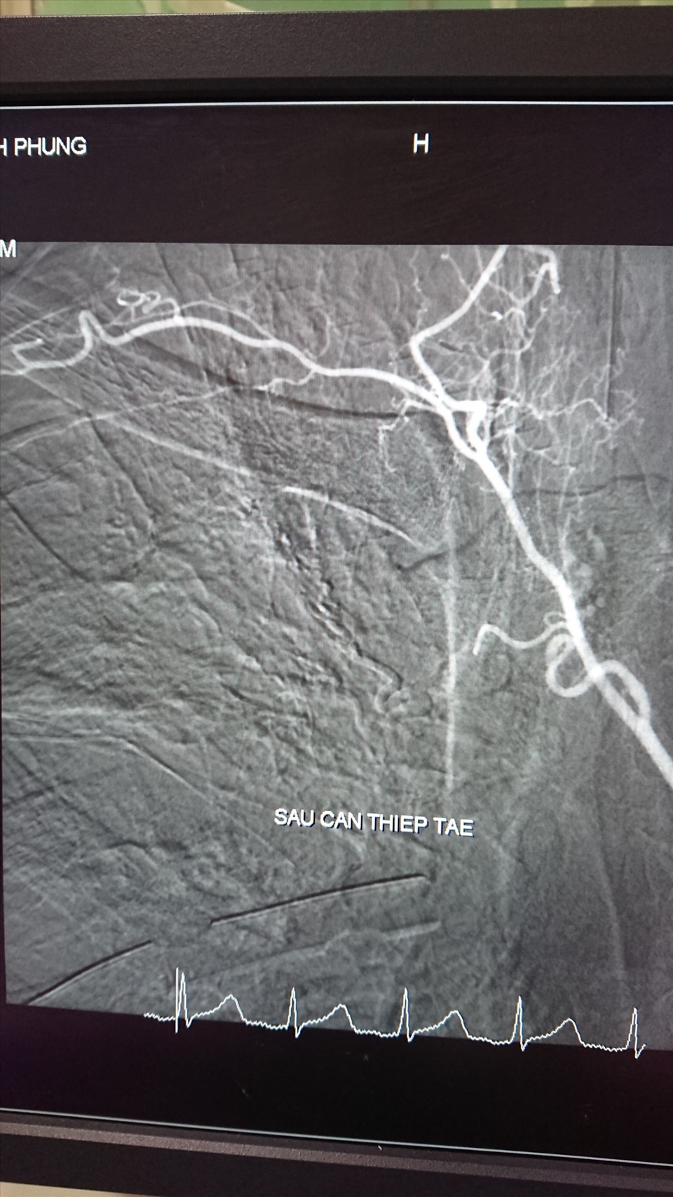 Hình động mạch sau khi được bác sĩ can thiệt. Ảnh: BVCC