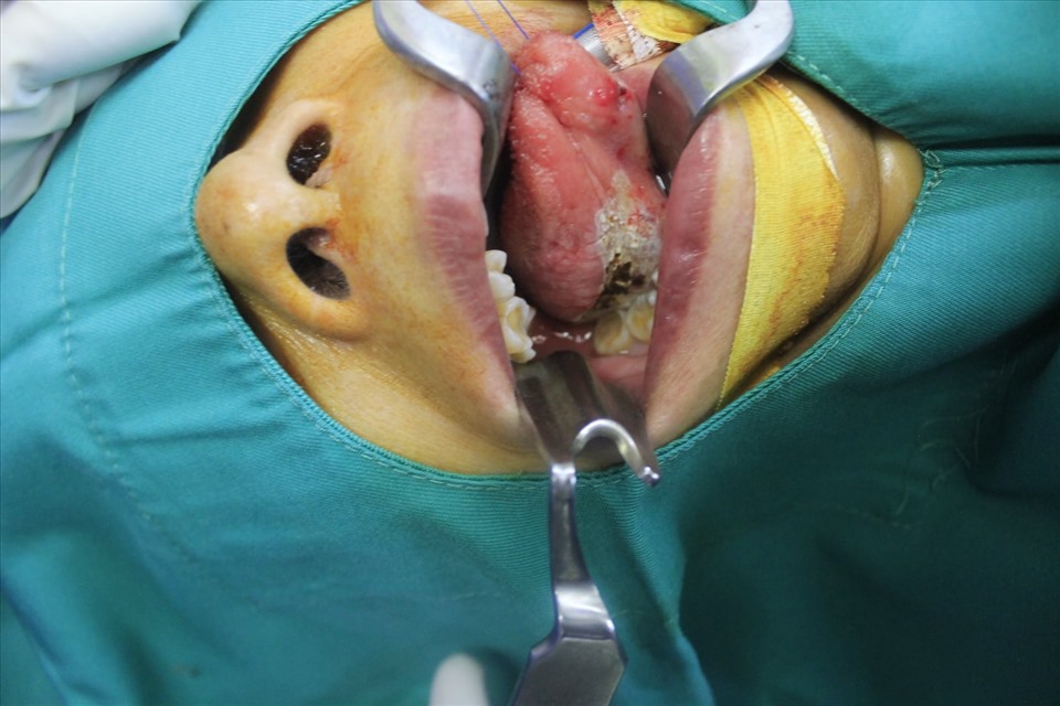 Hình ảnh tổn thương bạch sản trong miệng bệnh nhân. Ảnh: BVCC