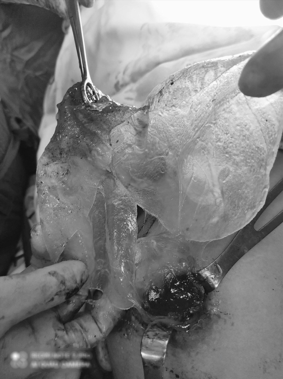 Phẫu thuật viên lấy túi ngực vỡ ra khỏi ngực bệnh nhân. Ảnh do bác sĩ cung cấp.