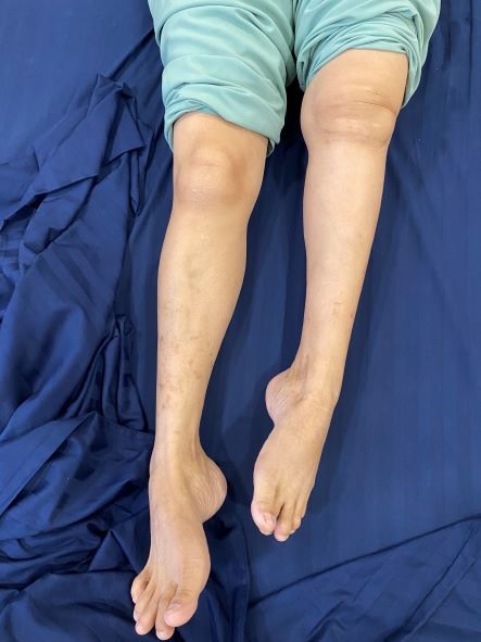 (Hình ảnh bệnh nhân trước khi mổ) Chân trái ngắn hơn chân phải khoảng 10cm, bệnh nhân không thể đi lại bằng chân trái.