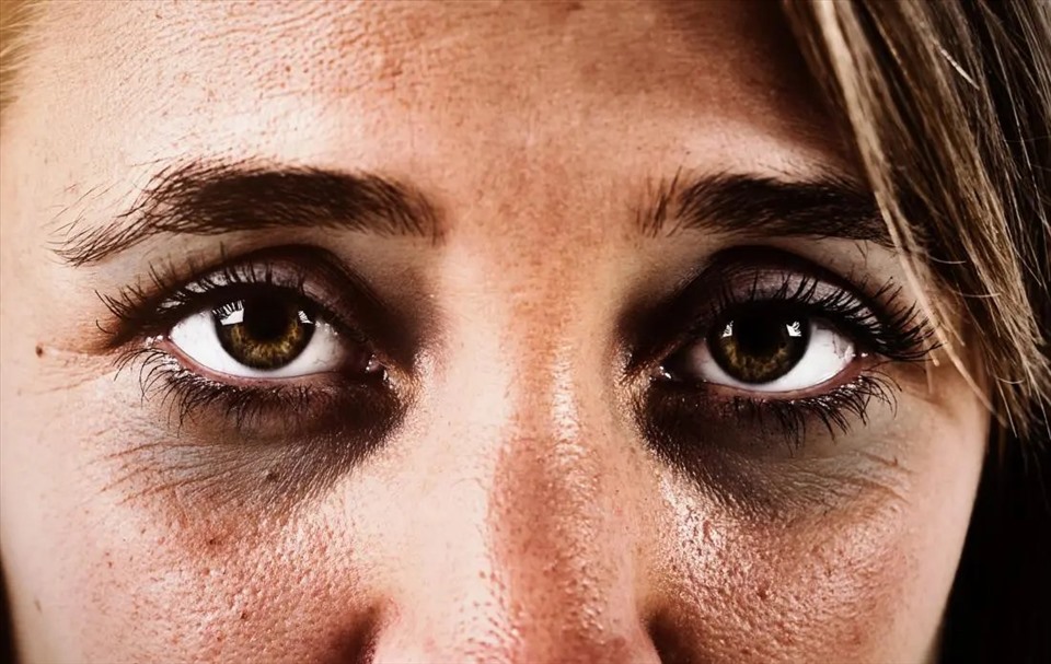 Quầng thâm mắt là hiện tượng thường thấy khi chị em phụ nữ gặp stress, thức khuya hoặc mất ngủ thường xuyên. Ảnh: Xinhua