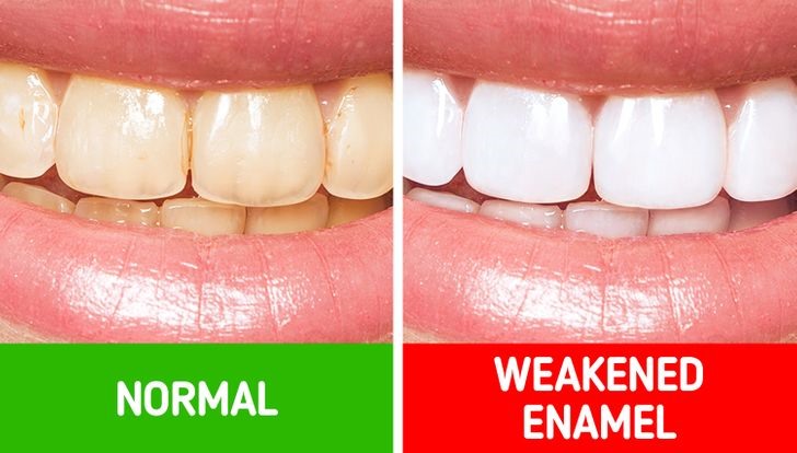 Thói quen 3: Không lạm dụng làm trắng răng Ngành thẩm mỹ thường quảng cáo quá đà về tác dụng làm trắng răng của các công nghệ mới. Tuy có thể làm trắng tức thời nhưng về lâu dài men răng của bạn sẽ bị ảnh hưởng rất lớn. Chúng sẽ chuyển sang màu ngà hơn theo thời gian. Làm trắng răng làm suy yếu men răng của bạn. Vì vậy, tốt hơn hết bạn nên tránh sử dụng công nghệ làm răng và kể cả các loại kem đánh răng làm trắng  vì nó mài mòn răng của bạn. Thay vào đó, hãy sử dụng kem đánh răng có chứa florua - thành phần ngăn ngừa sâu răng.