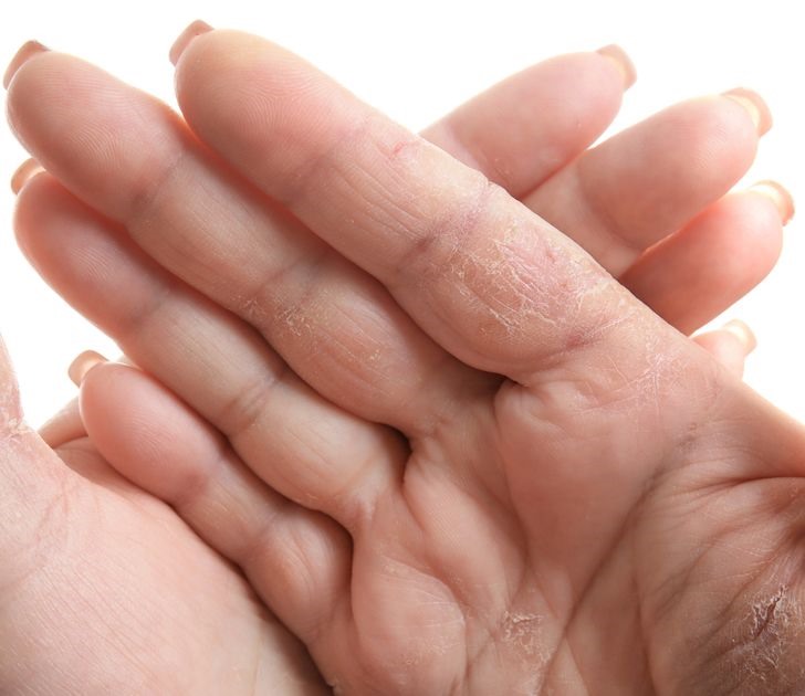 6. Khô da tay và da trên cơ thể  Da khô là hiện tượng phổ biến trong mùa lạnh nhưng việc sử dụng kem dưỡng ẩm, uống nhiều nước và bổ sung vitamin là khá hữu ích. Nếu các giải pháp nêu trên không giúp cải thiện tình trạng thì tốt hơn hết bạn nên đến gặp bác sĩ da liễu vì da khô cũng là một trong những dấu hiệu phổ biến của bệnh tiểu đường và suy giáp. Nếu da của bạn không chỉ thô ráp và bong tróc mà xuất hiện vết nứt, nó có thể là  dấu hiệu viêm da do tiếp xúc với hóa chất.