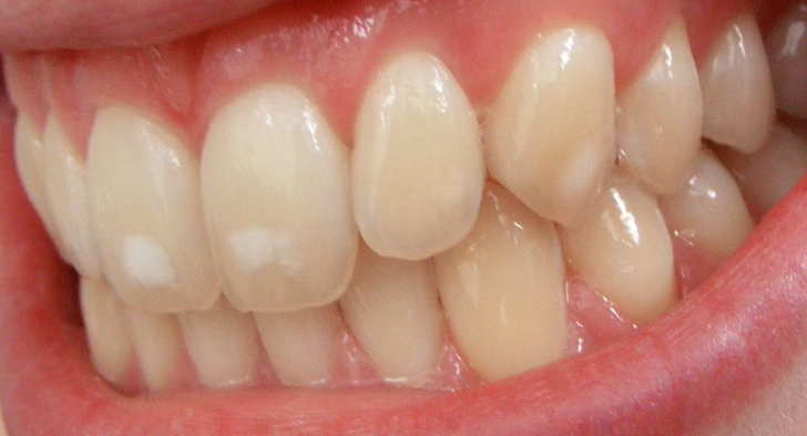 7. Vết ố trên răng Răng nhiễm fluor là tình trạng bề mặt răng xuất hiện các đốm màu sắc trắng đục và thường là các đốm trắng li ti hoặc các mảng màu nhỏ không đều và nằm rải rác khắp bề mặt các răng. Nếu bệnh nhân mắc bệnh răng bị nhiễm fluor thì có thể không điều trị tận cùng được mà răng sẽ bị đổi màu răng và gây ra các tình trạng xấu khác cho răng miệng như mô răng bị phá huỷ.