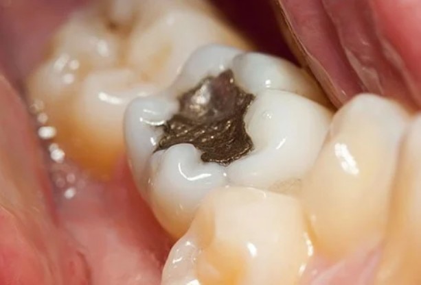 Sâu răng:  Trên thực tế, hơn 90% người trưởng thành đã từng bị sâu răng, với số lỗ sâu răng trung bình trong miệng người lớn là khoảng 3 vị trí. Hầu hết các lỗ sâu răng đó đã được khoan và trám, nhưng các vết trám này cũng có thể là nơi ẩn náu của vi khuẩn gây hôi miệng.