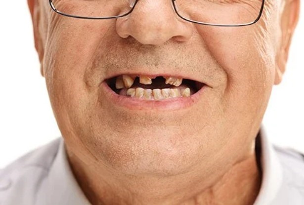 Vệ sinh răng miệng kém:  Không đánh răng thường xuyên, những người tiếp xúc với bạn sẽ nhanh chóng nhận ra mùi khó chịu. Việc không chăm sóc răng miệng hàng ngày để lại mùi hôi khó chịu do vi khuẩn bám lại, có thể dẫn đến sâu răng và gây hôi miệng. Hiệp hội Nha khoa Hoa Kỳ khuyến nghị nên đánh răng hai lần một ngày, mỗi lần hai phút bằng bàn chải lông mềm và dùng chỉ nha khoa hàng ngày.