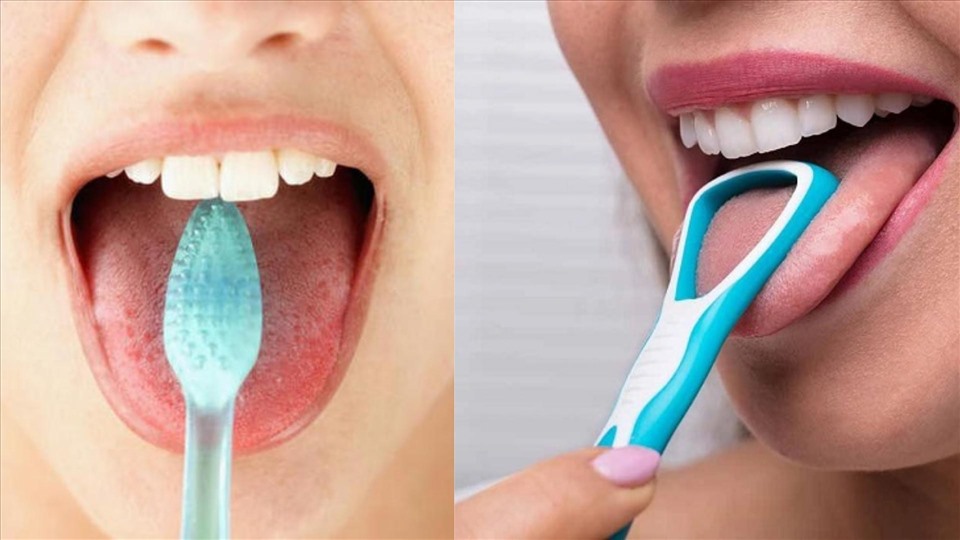 Cạo lưỡi nhẹ nhàng để loại bỏ vi khuẩn gây mùi cho miệng. (Đồ họa: VA)