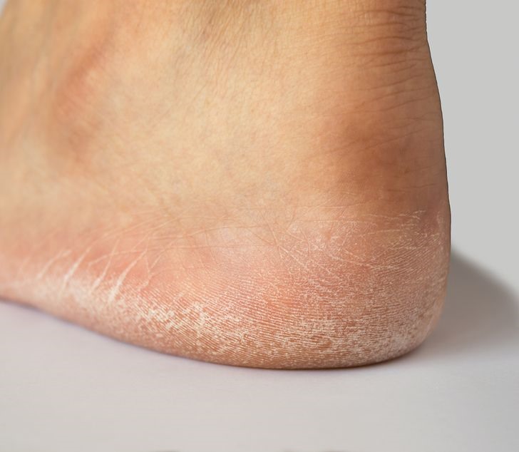 Dấu hiệu 4: Gót chân nứt nẻ Gót chân nứt nẻ có thể do khô da, thời tiết lạnh hoặc do bạn đứng nhiều giờ mỗi ngày. Tuy nhiên, chúng có thể là dấu hiệu của các vấn đề nghiêm trọng hơn, chẳng hạn như bệnh chàm, suy giáp và tiểu đường. Bạn có thể xử lý gót chân bằng cách  ngâm chúng trong nước xà phòng trong 20 phút và chà chúng bằng bọt. Sau đó, bạn sẽ cần thoa một loại kem dưỡng ẩm có thành phần axit lactic, dầu jojoba hoặc bơ.  Nếu các phương pháp điều trị tại nhà không cải thiện tình trạng gót chân, bạn cần đến gặp bác sĩ thăm khám, kê đơn.