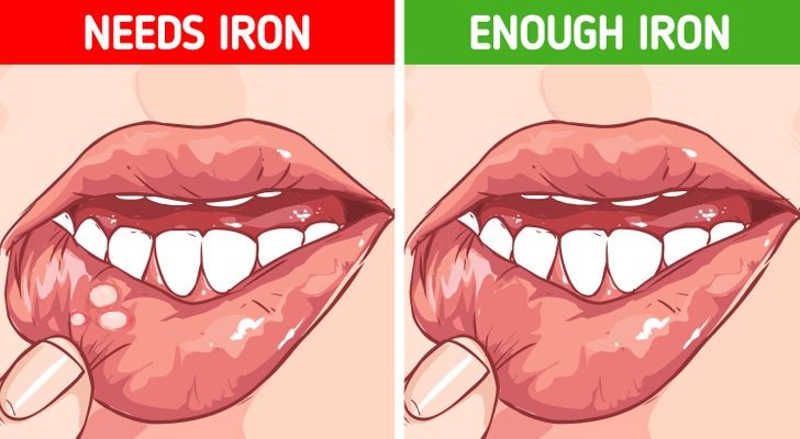 Dấu hiệu 2: Vết loét trên miệng và lưỡi  Những lý do phổ biến nhất cho sự xuất hiện của vết loét là hút thuốc, dị ứng, vô tình cắn vào lưỡi hoặc bị viêm. Tuy nhiên, nếu bạn không phải trường hợp nào kể trên mà vẫn xuất hiện vết loét này thì có thể bạn đã bị thiếu  vitamin-B12, sắt hoặc folate . Việc thiếu hụt không gây ra hậu quả một sớm một chiều mà âm thầm khiến sức khoẻ xấu đi. Một số dấu hiệu cảnh báo khác có thể là  mệt mỏi, chóng mặt, nhịp tim không đều và yếu cơ. Bạn sẽ phải thay đổi chế độ ăn uống và bổ sung các chất cần thiết còn thiếu.