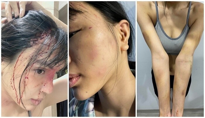 Hình ảnh Khả Trang với toàn thân tím bầm nằm trong bệnh viện