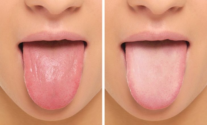 Sưng và đau lưỡi, miệng Nhìn vào bên trong miệng có thể cung cấp cho chúng ta rất nhiều manh mối về sức khỏe của chúng ta. Thiếu sắt là một trong số đó. Ví dụ, nếu lưỡi bị sưng, viêm hoặc đổi màu thì đây là dấu hiệu của tình trạng thiếu sắt. Trong cơ thể chúng ta có một loại protein gọi là myoglobin , một loại protein liên kết với sắt và oxy được tìm thấy trong mô cơ của lưỡi. Mức myoglobin thấp hơn có thể khiến lưỡi bị đau, trơn và sưng. Thiếu sắt cũng có thể dẫn đến khô miệng và các vết nứt đỏ lở loét ở khóe miệng.