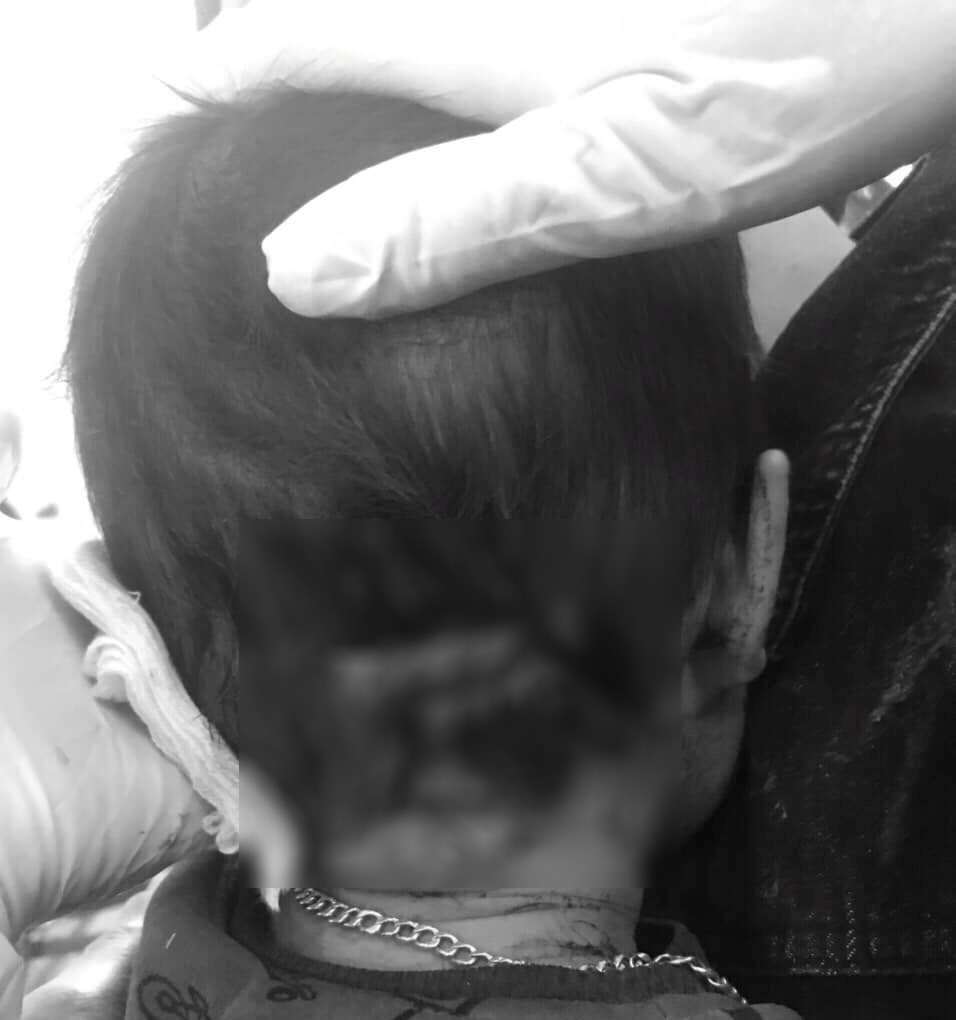 Một cháu nhỏ bị chó căn gây thương tích ở vùng đầu.