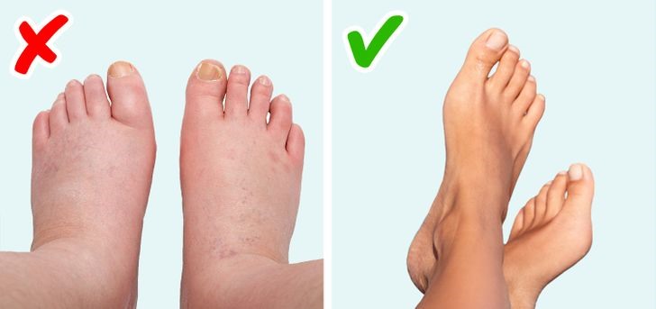 4. Ngón chân sưng tấy Triệu chứng này có thể báo hiệu bệnh viêm khớp vảy nến. Bác sĩ bạn nên khám là bác sĩ da liễu; bác sĩ chuyên khoa thấp khớp.