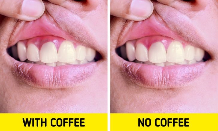 Có hại cho răng: Một trong những triệu chứng khó chịu nhất khi cai nghiệm cà phê là buồn nôn. Mặc dù uống cà phê thường xuyên có thể khiến răng bạn ố vàng, nhưng việc nôn mửa vì bỏ cà phê có thể gây khô miệng và mòn răng, khiến răng nhạy cảm hơn và dễ bị sâu răng.