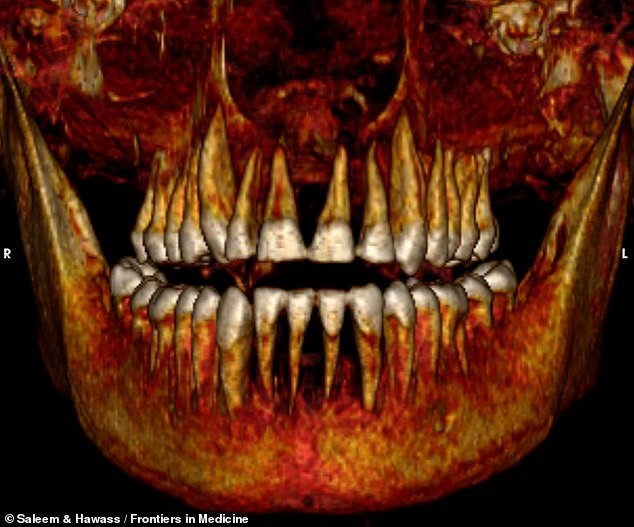 Ảnh chụp CT cho thấy ông có bộ răng đều và chắc khỏe. Ảnh: