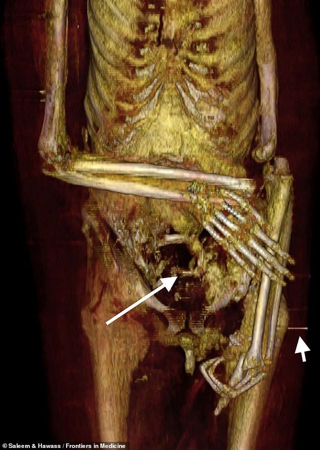 Ảnh chụp CT phần thân dưới của Amenhotep I. Nhóm nghiên cứu tin rằng, ông ban đầu được chôn cất với 2 tay khoanh trước ngực. Tuy nhiên, những kẻ trộm mộ đã khiến hài cốt bị trật khớp tay phải và gãy 2 ngón tay ở bàn tay trái. Ảnh: