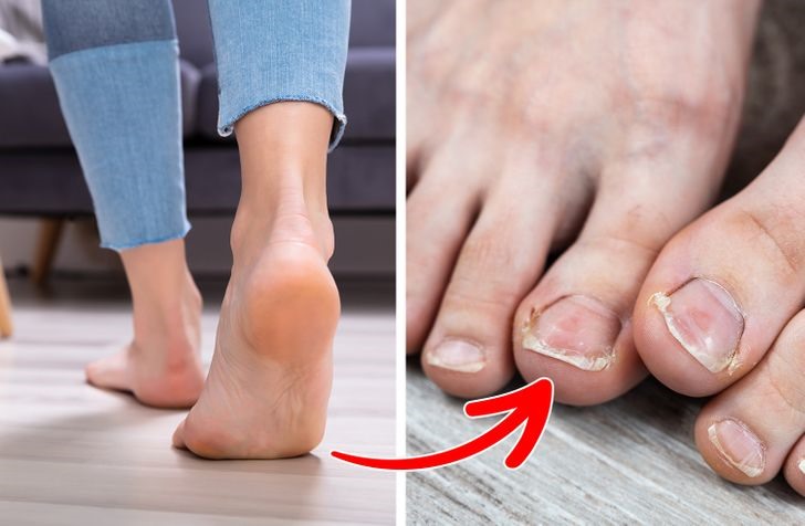 Bàn chân của bạn sẽ tiếp xúc với nhiều vi khuẩn. Ngay cả khi bạn vừa mới lau sàn, không có nghĩa là nó hoàn toàn không có vi khuẩn. Sàn nhà của bạn trông có vẻ sạch sẽ nhưng thực tế vẫn còn rất nhiều bụi và nấm có hại. Nếu bạn đi lại bằng chân trần, bạn đang tiếp xúc với các vi sinh vật có thể lây nhiễm sang da chân của bạn. Do đó, điều này có thể làm nhiễm trùng phần móng chân của bạn và khiến chúng chuyển sang màu vàng và giòn, dễ hư hại.