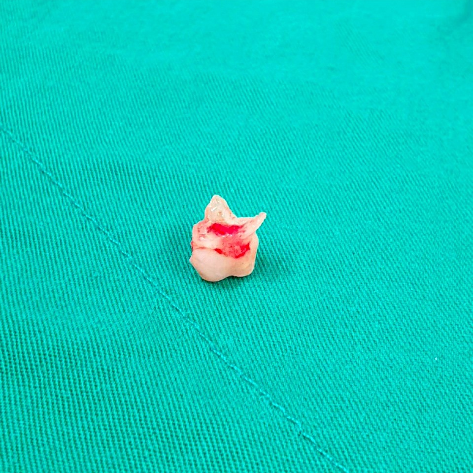 Chiếc răng được gắp ra từ phổi của bé gái. Ảnh: BSCC.
