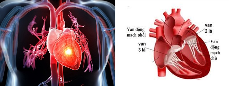 Hở van tim là căn bệnh phổ biến trong các bệnh lý về tim. Đồ họa: Hồng Nhật