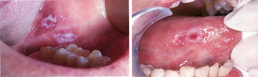 Những xuất hiện bất thường trong khoang miệng có thể là dấu hiệu của bệnh ung thư khoang miệng. Đồ họa: Hồng Nhật