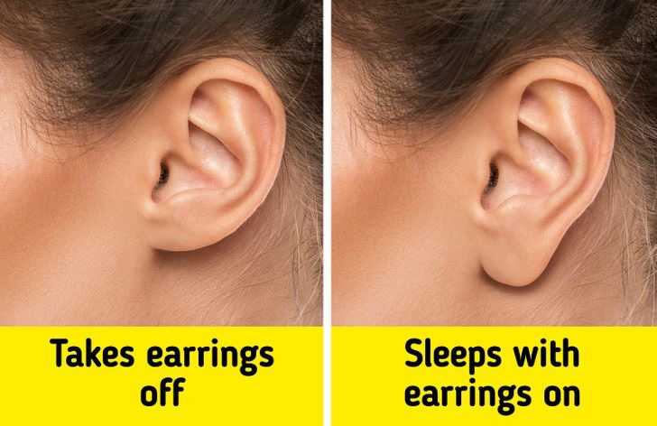 4. Dái tai bị chảy xệ Đeo bông tai lớn và nặng có thể khiến dái tai bị lão hóa và dài ra. Dái tai mất tính đàn hồi theo năm tháng, có thể bị xệ và chùng xuống. Đeo hoa tai vào ban đêm cũng có thể khiến bông tai có mùi khó chịu do chất nhờn trên da tiết ra bị trộn lẫn với các tế bào da chết và vi khuẩn.