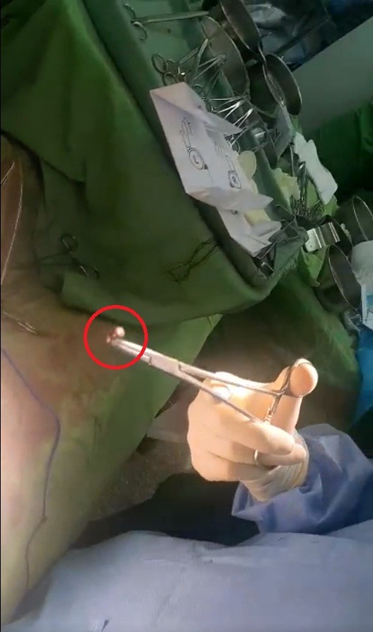 Viên đạn được các bác sĩ lấy từ người bệnh nhân. Ảnh: BVCC