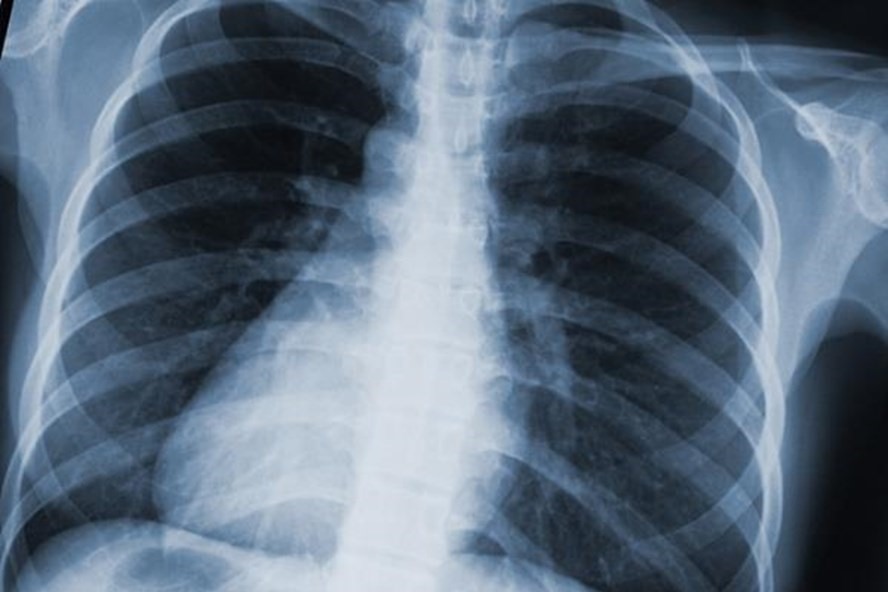 Tiếp xúc nhiều với tia X trong chụp X-quang sẽ không tốt cho sức khỏe. Ảnh LĐO