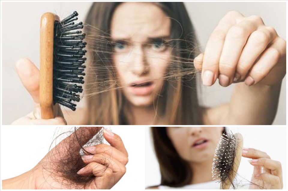 Rụng tóc ở giai đoạn ngừng phát triển của tóc TE