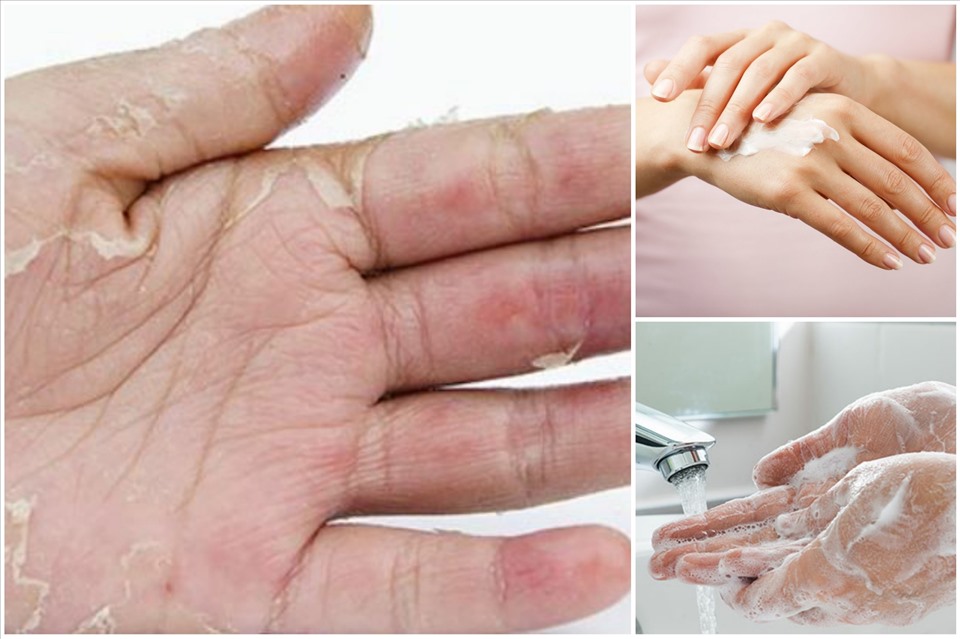 Rửa tay quá nhiều, dùng mỹ phẩm không phù hợp sẽ dẫn đến tình trạng tróc da tay. Đồ họa: Ánh Nhiên