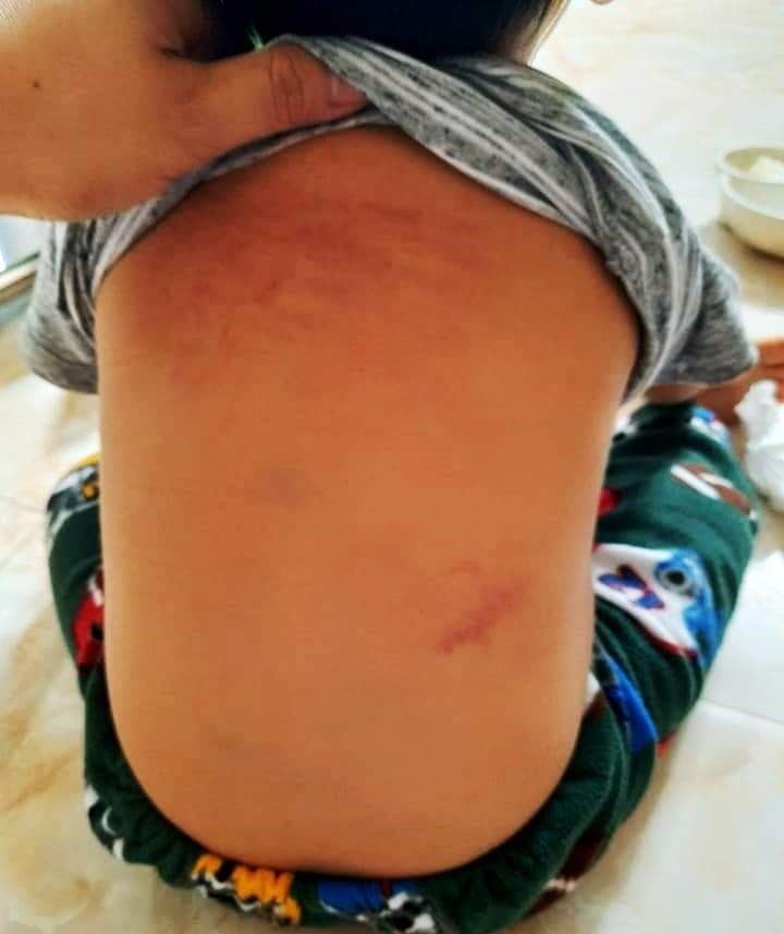 Hình ảnh cháu bé bị bạo hành với nhiều vết bầm tím ở phần lưng. Ảnh: NT