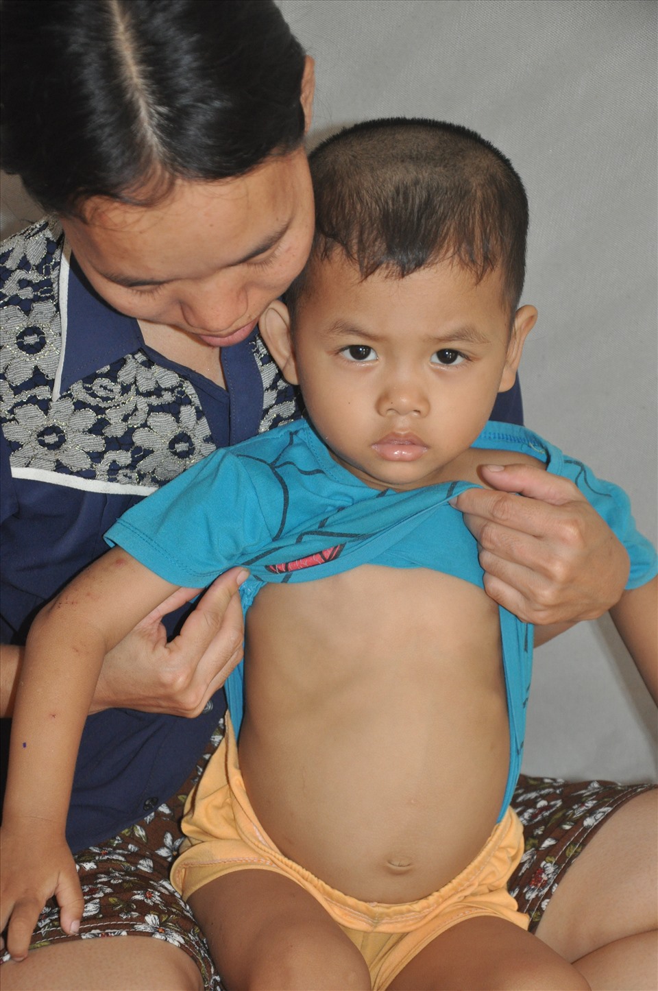 Em trai Minh Khôi (4 tuổi) cũng bị bệnh như anh nên việc điều trị xác định theo cả đời.
