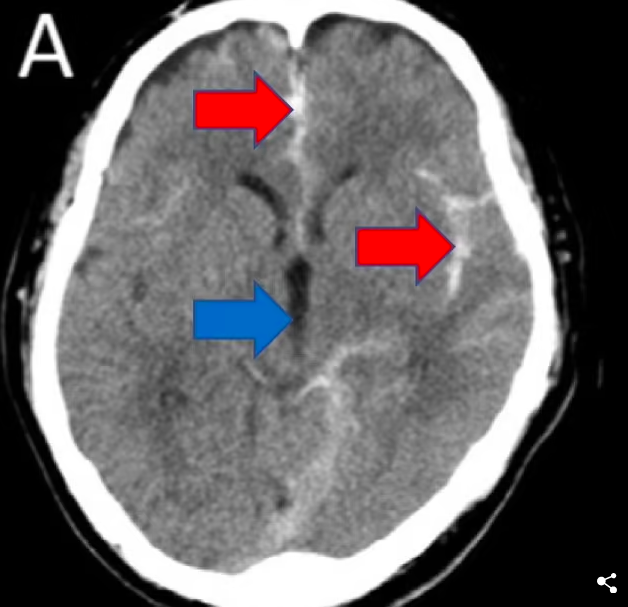 Ảnh chụp CT cho thấy người đàn ông bị chảy máu não. Vật chất màu trắng được chỉ ra bởi các mũi tên đỏ là máu tươi không nên có. Những khoảng trống đó phải được lấp đầy bởi dịch não tủy, trông giống như khu vực được đánh dấu bằng mũi tên màu xanh lam