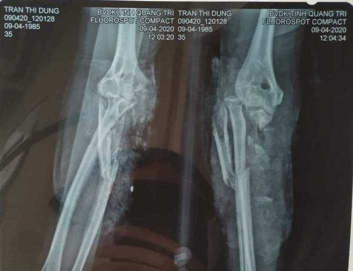 Hình ảnh phim xương cánh tay phải của chị Dung sau khi bị tai nạn lao động. Ảnh: Hưng Thơ.