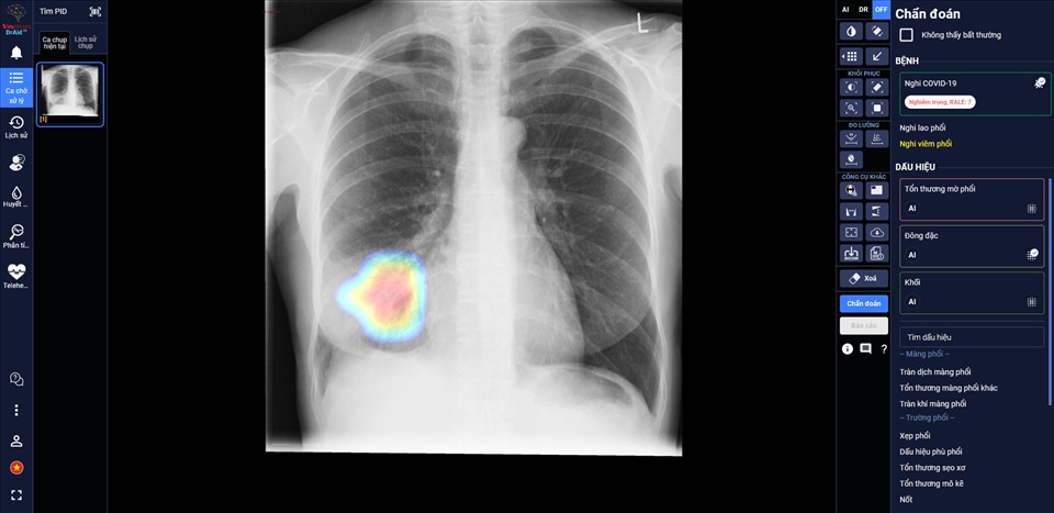 DrAid giúp bác sĩ theo dõi mức độ tổn thương phổi ở một bệnh nhân F0 trên ảnh X-quang phổi.