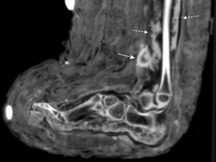 Hình ảnh chụp CT vết thương của xác ướp Ai Cập. Ảnh: Elsevier