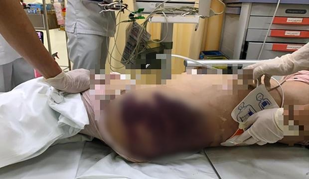 Những vết bầm lớn được xác định xuất hiện trên cơ thể bé gái 8 tuổi khi nhập viện