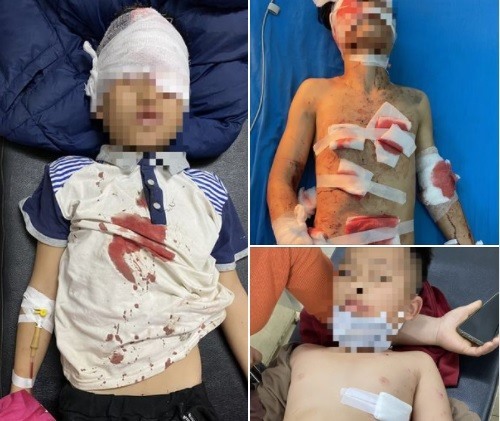 4 cháu nhỏ tại Tuyên Quang bị thương tích nặng do đốt pháo mua từ trên mạng. Ảnh: BVCC