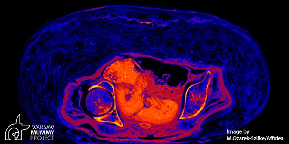 Ảnh chụp xác ướp, với phần mô mềm được xác định là bào thai được tô màu đỏ. Ảnh: Dự án xác ướp Warsaw