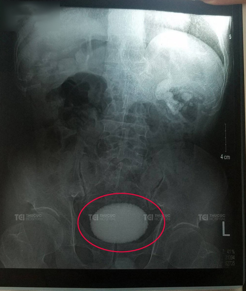 Viên sỏi bàng quang có hình dáng và kích thước tương tự như quả trứng vịt trên phim chụp X-Quang của bệnh nhân T.