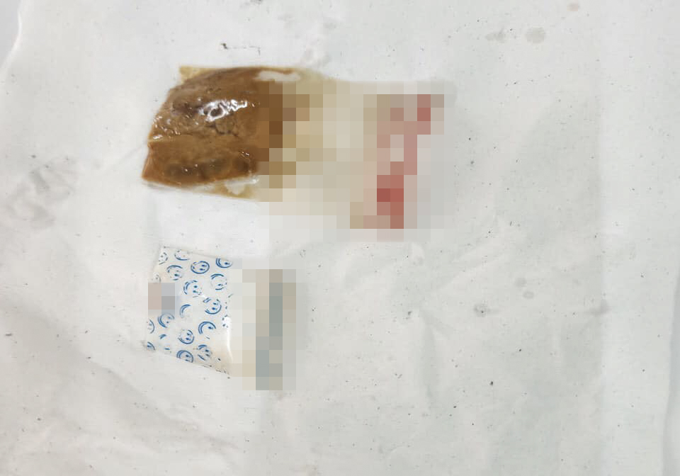 2 gói ma túy tang vật được bác sĩ gắp ra từ trong ống thực quản. Ảnh: CTV