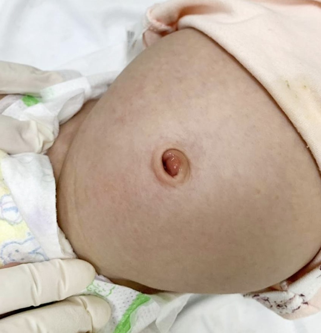 Hình ảnh rốn trẻ sơ sinh bị nhiễm trùng và cách xử lý