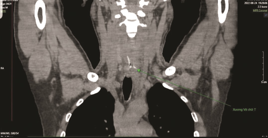 Dị vật xương vịt trên phim CT Scanner (mũi tên). Ảnh: BVCC