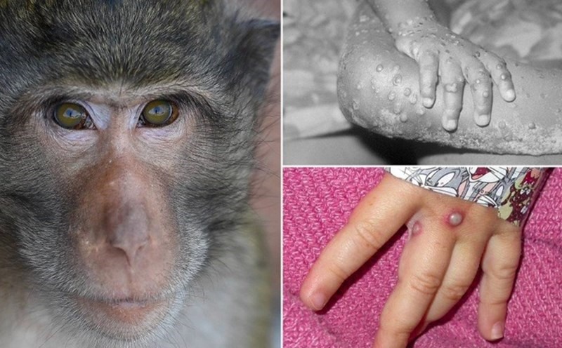 Bệnh đậu mùa khỉ gây quan ngại trên toàn cầu. Ảnh đồ họa: LĐO